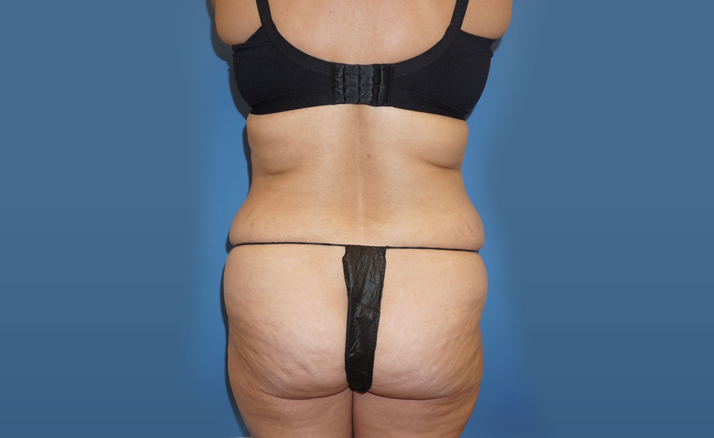 Liposuction – Patient 11 Before