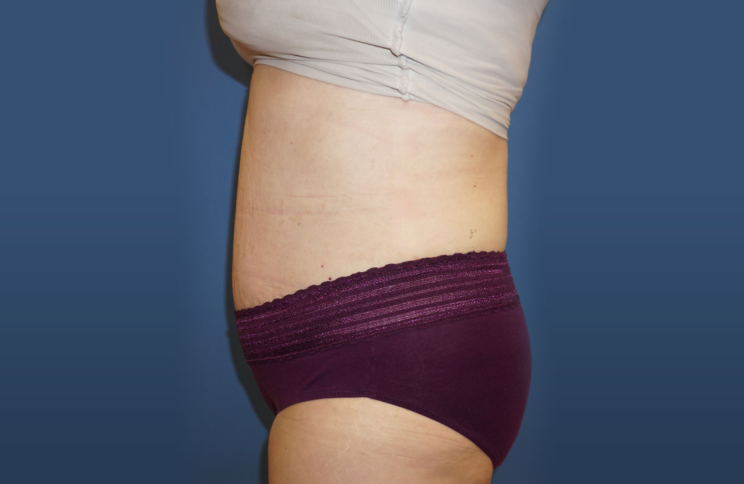 Tummy Tuck – Patient 13 After
