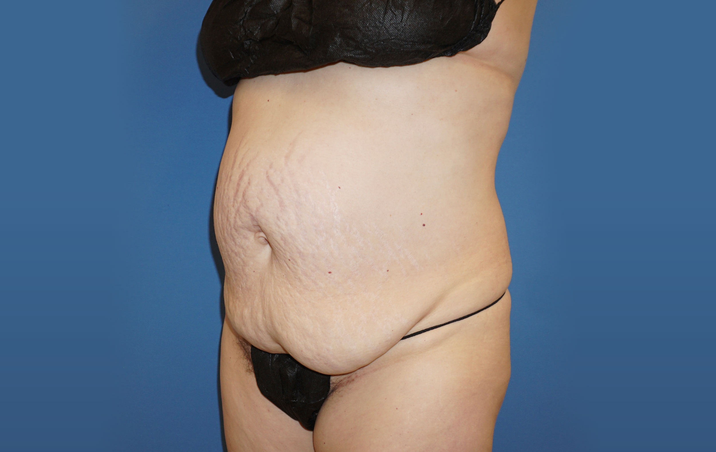 Tummy Tuck – Patient 13 Before