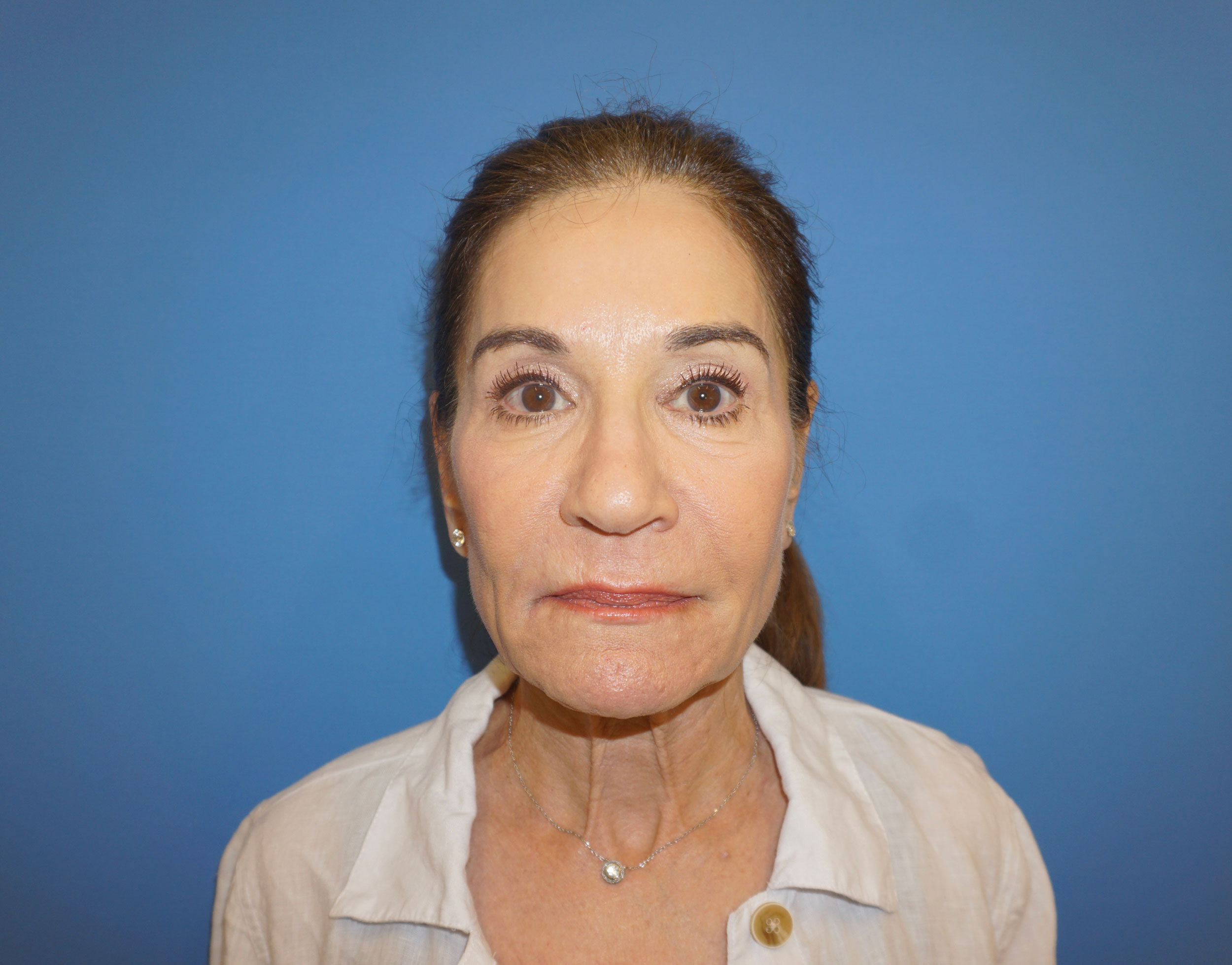 Blepharoplasty – Patient 20 After