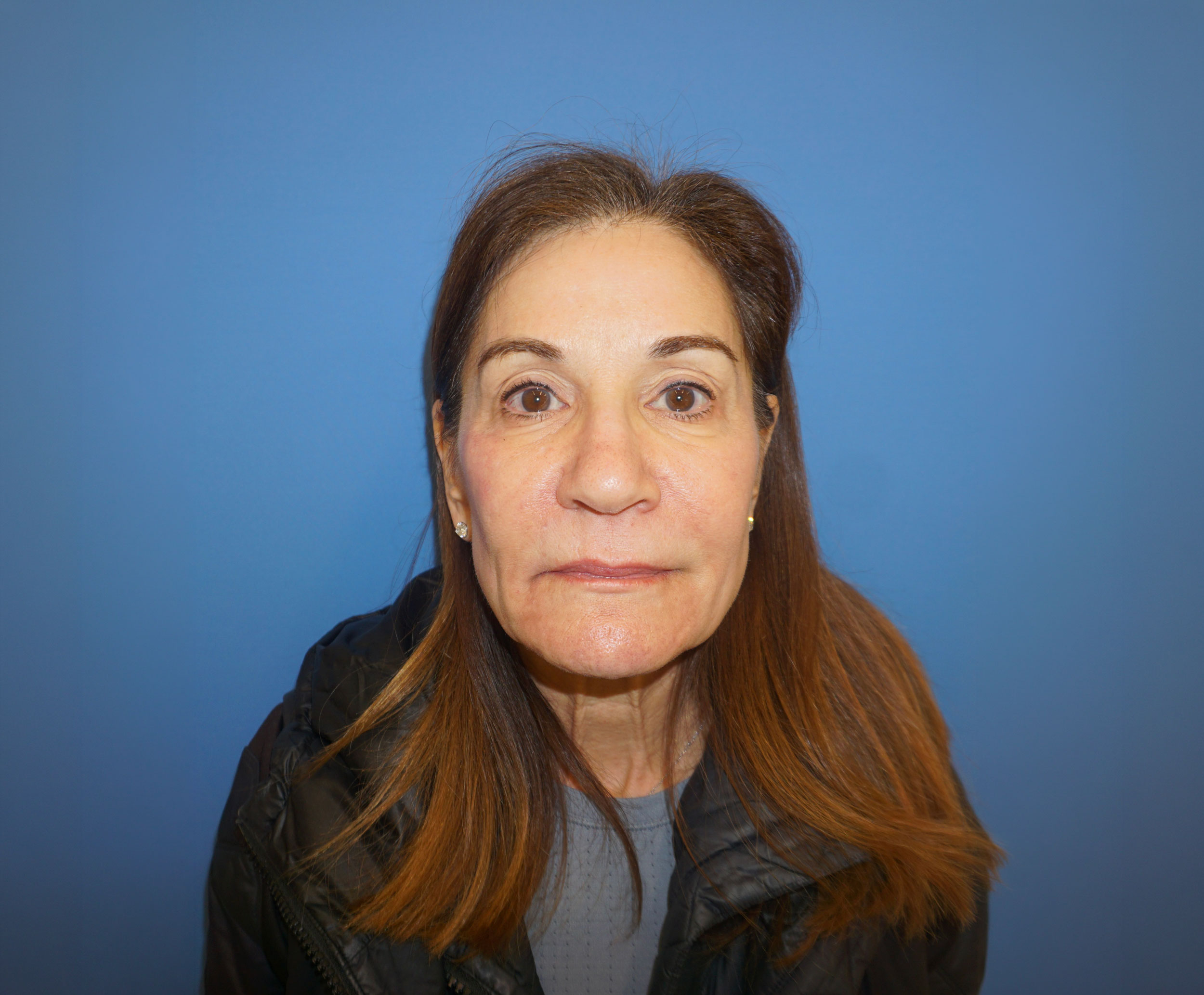 Blepharoplasty – Patient 20 Before