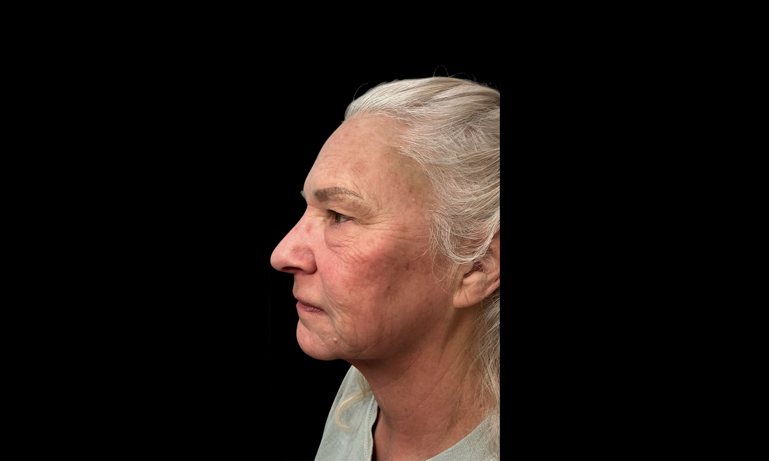 Laser Treatment – Patient 10 After Side Angle