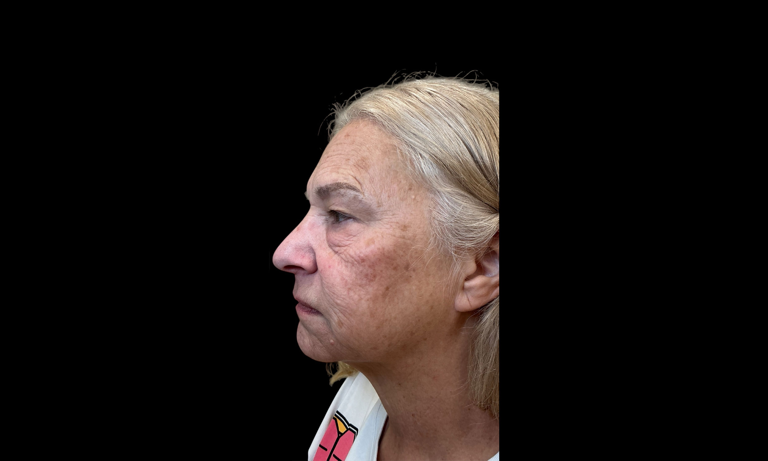 Laser Treatment – Patient 10 Before Side Angle
