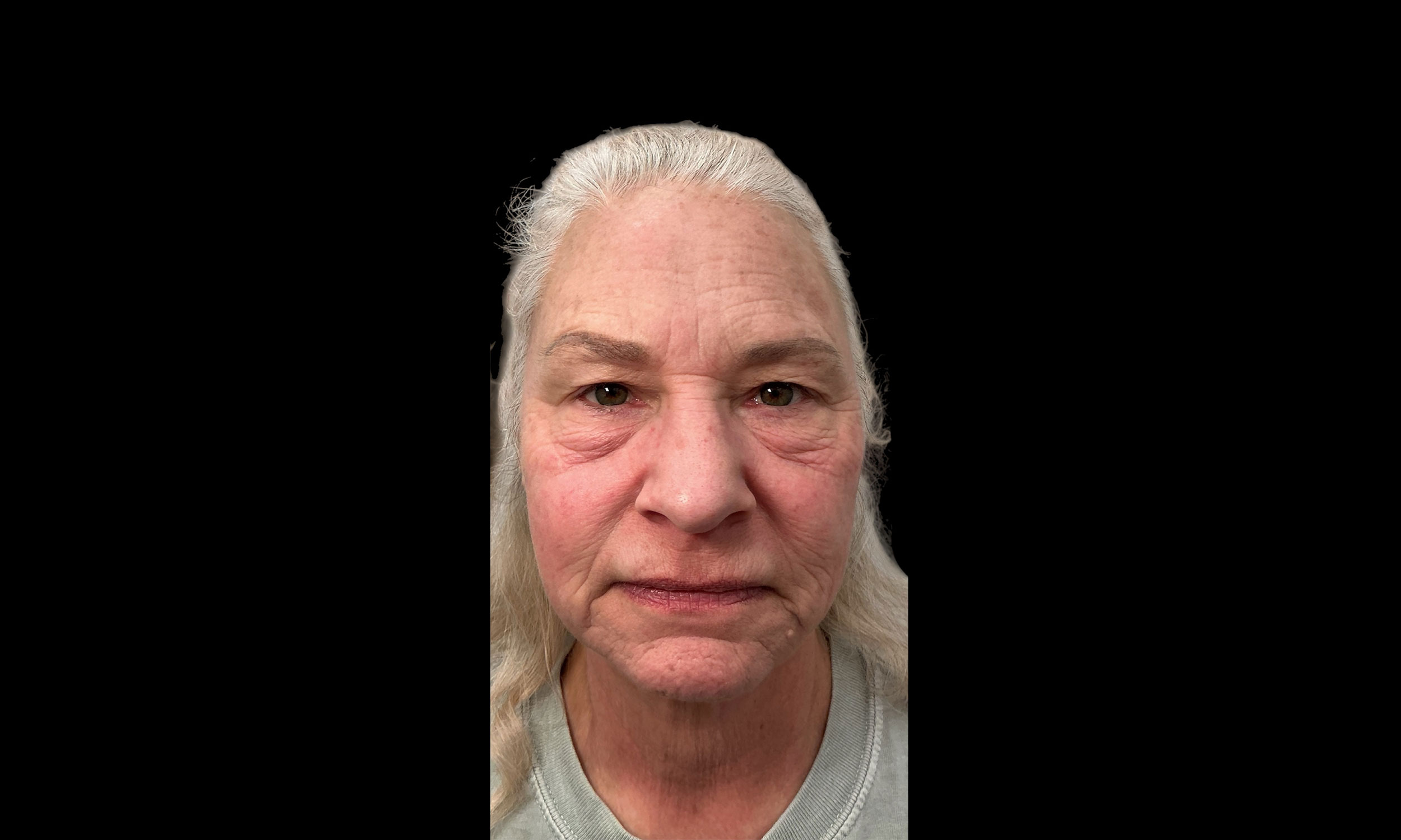 Laser Treatment – Patient 10 After