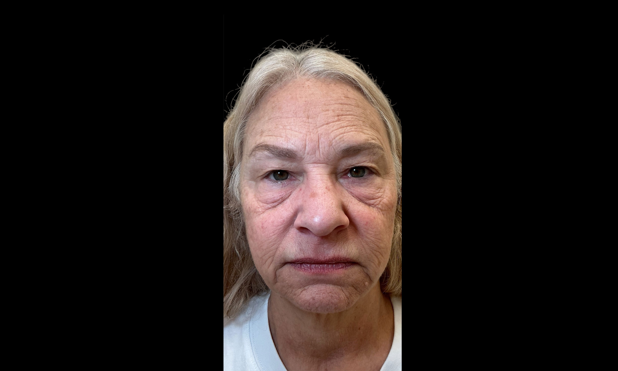 Laser Treatment – Patient 10 Before