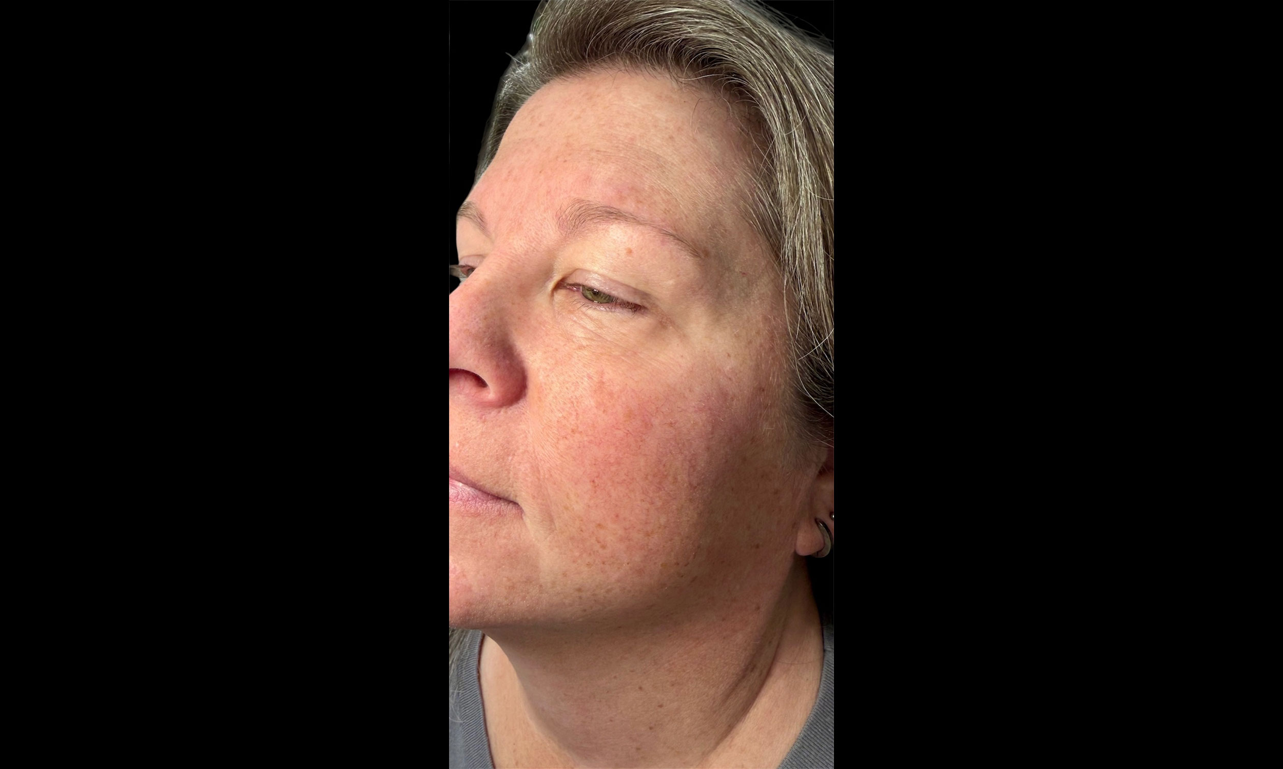 Laser Treatment – Patient 11 After