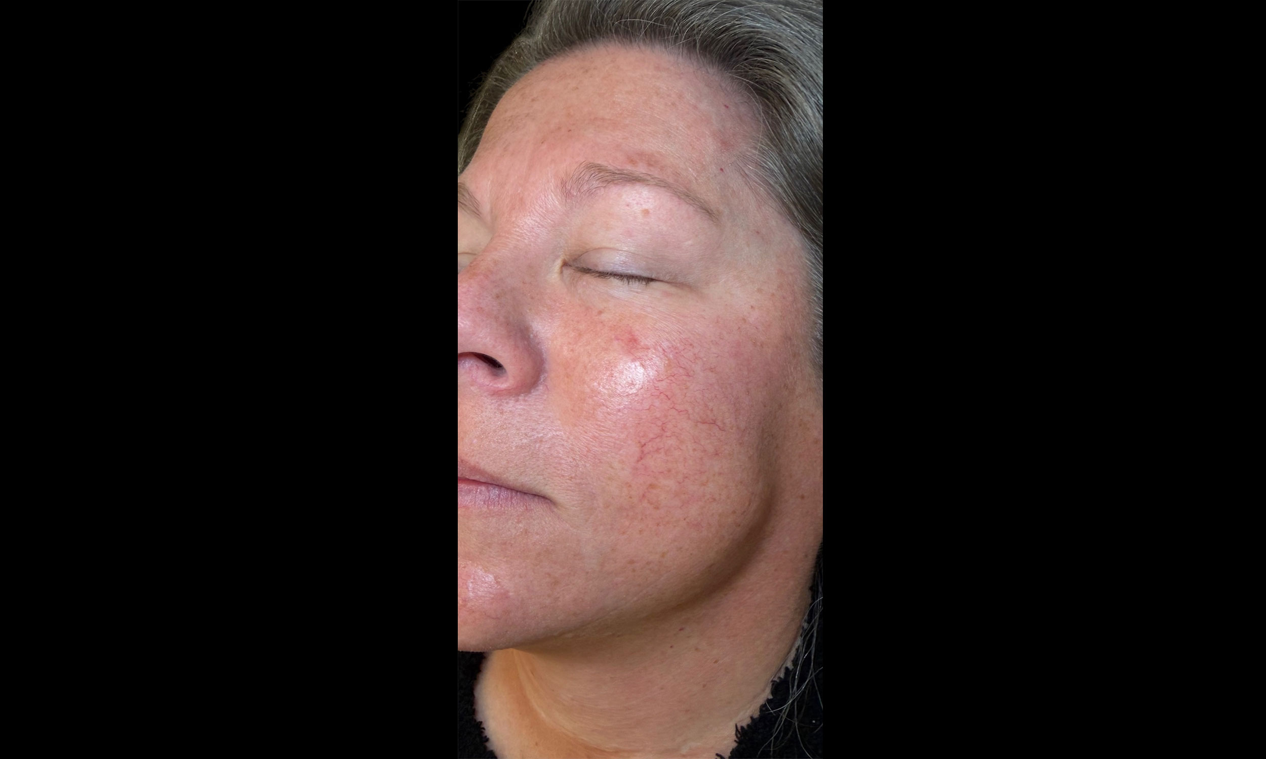 Laser Treatment – Patient 11 Before