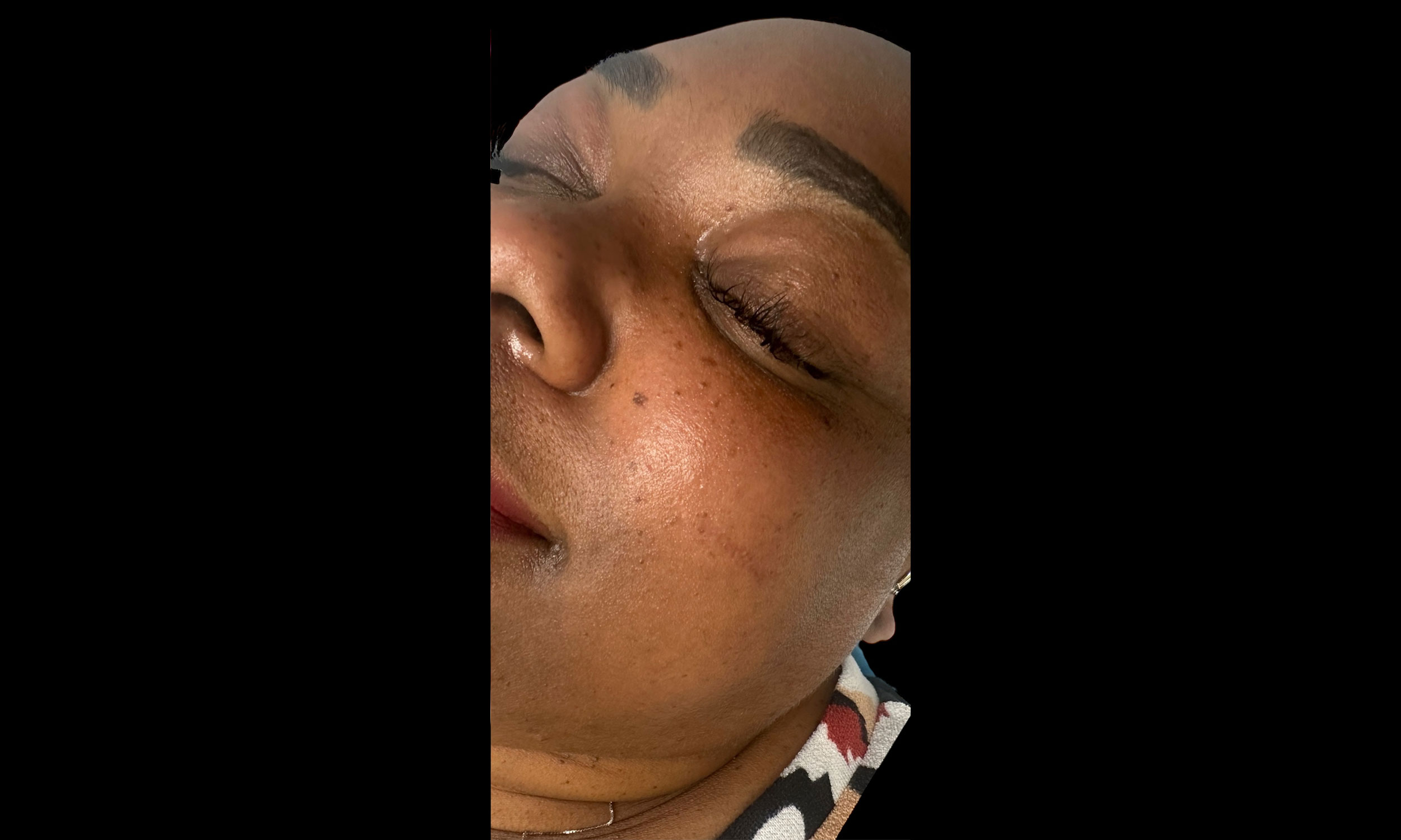 Laser Treatment – Patient 9 After