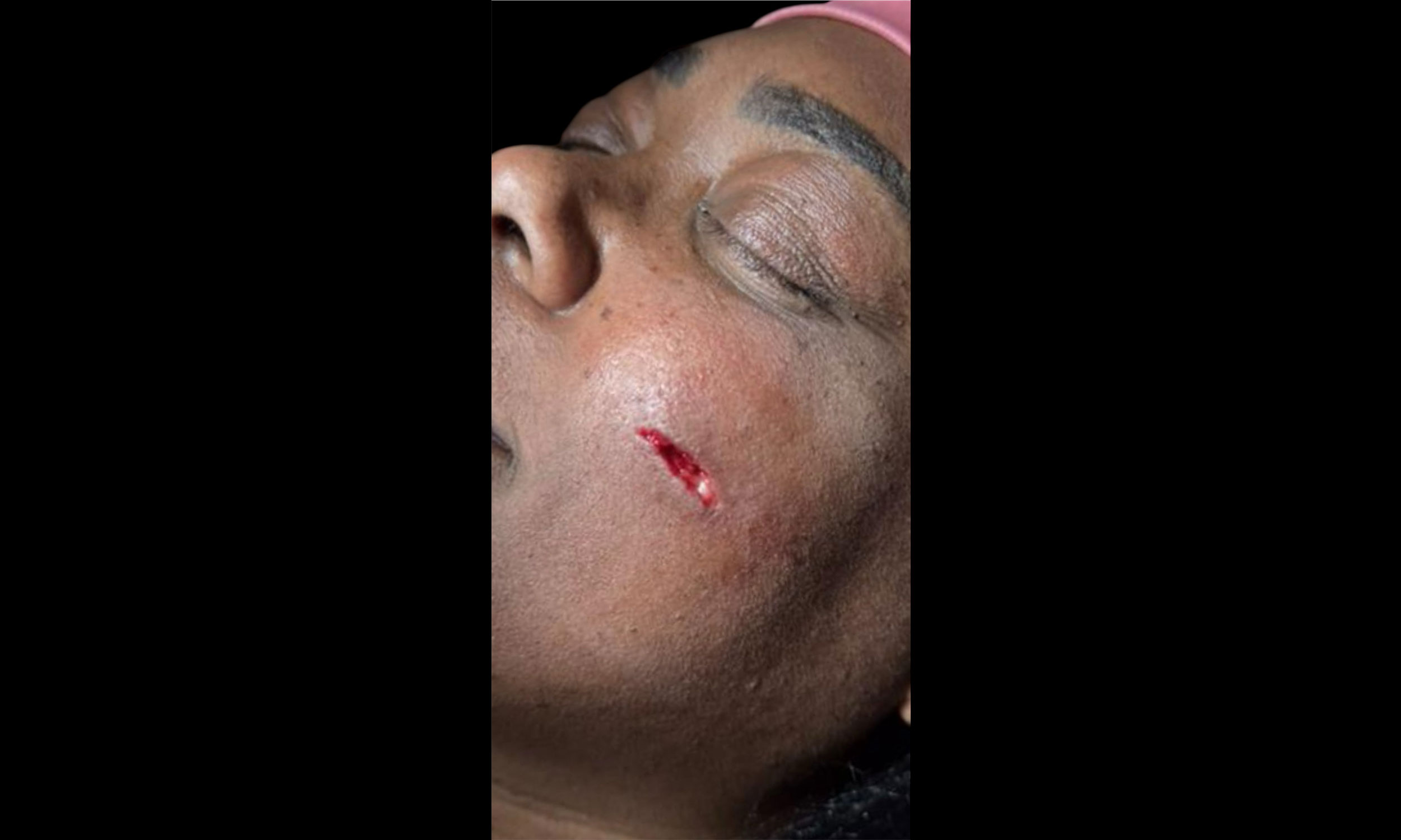 Laser Treatment – Patient 9 Before