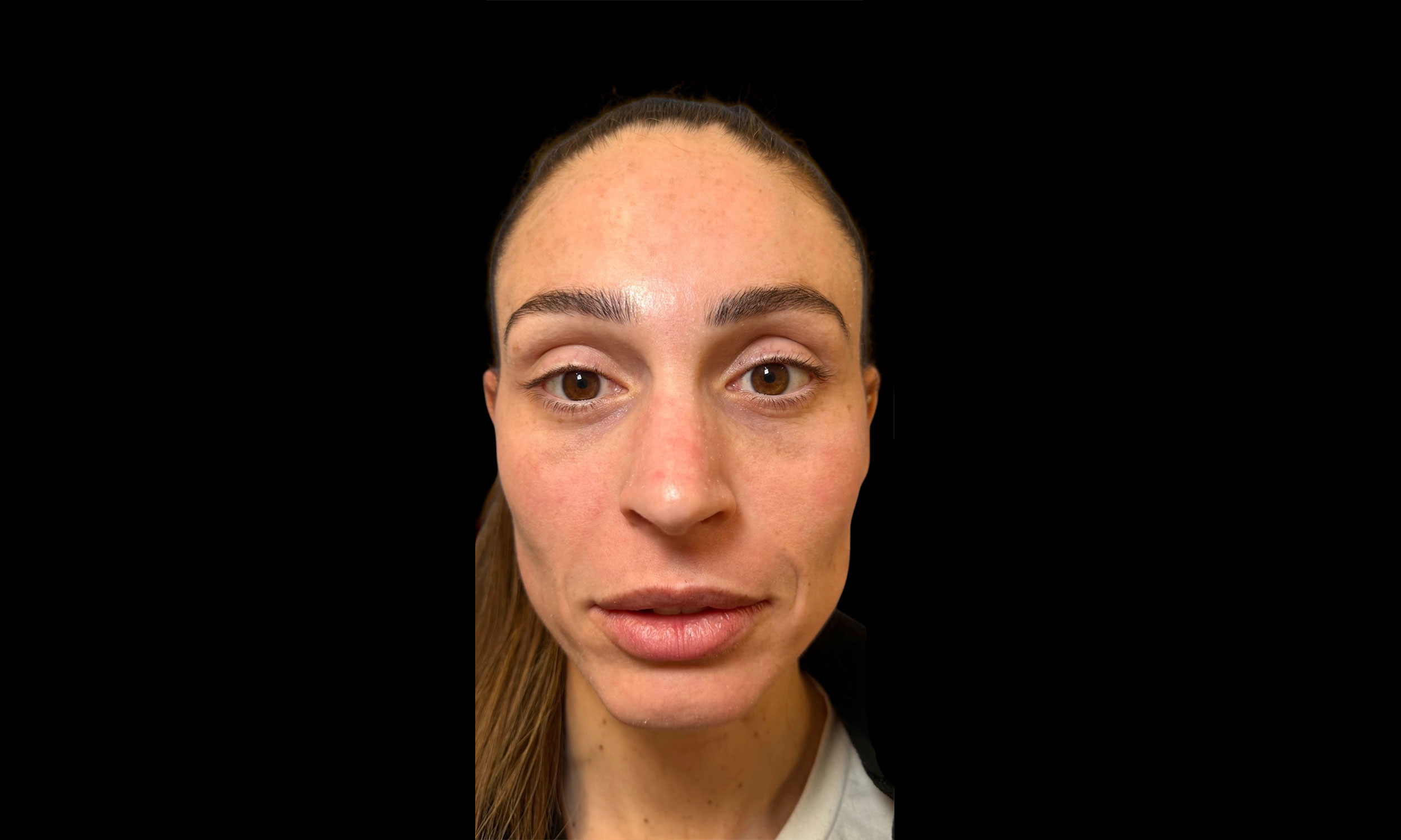 Laser Treatment – Patient 7 After