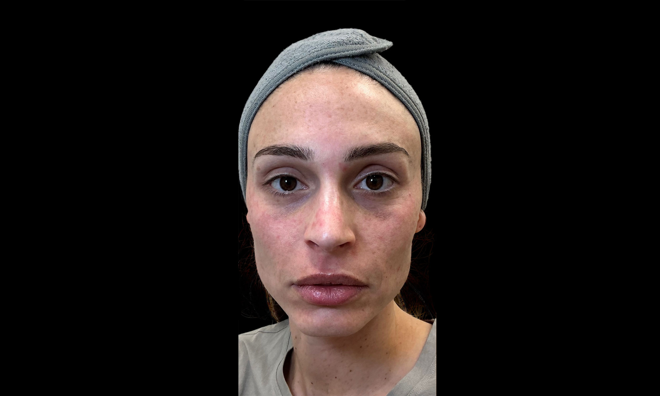 Laser Treatment – Patient 7 Before