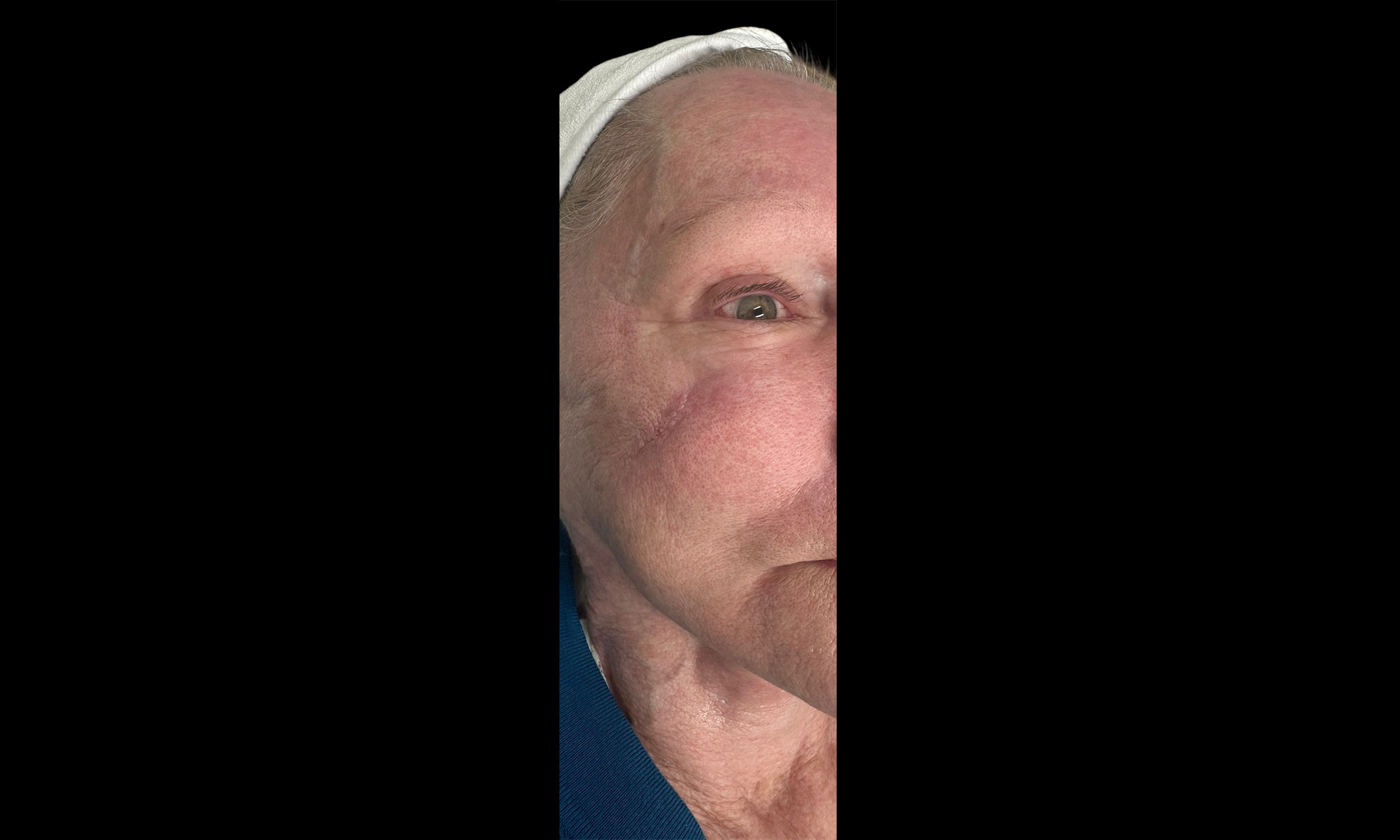 Laser Treatment – Patient 8 After