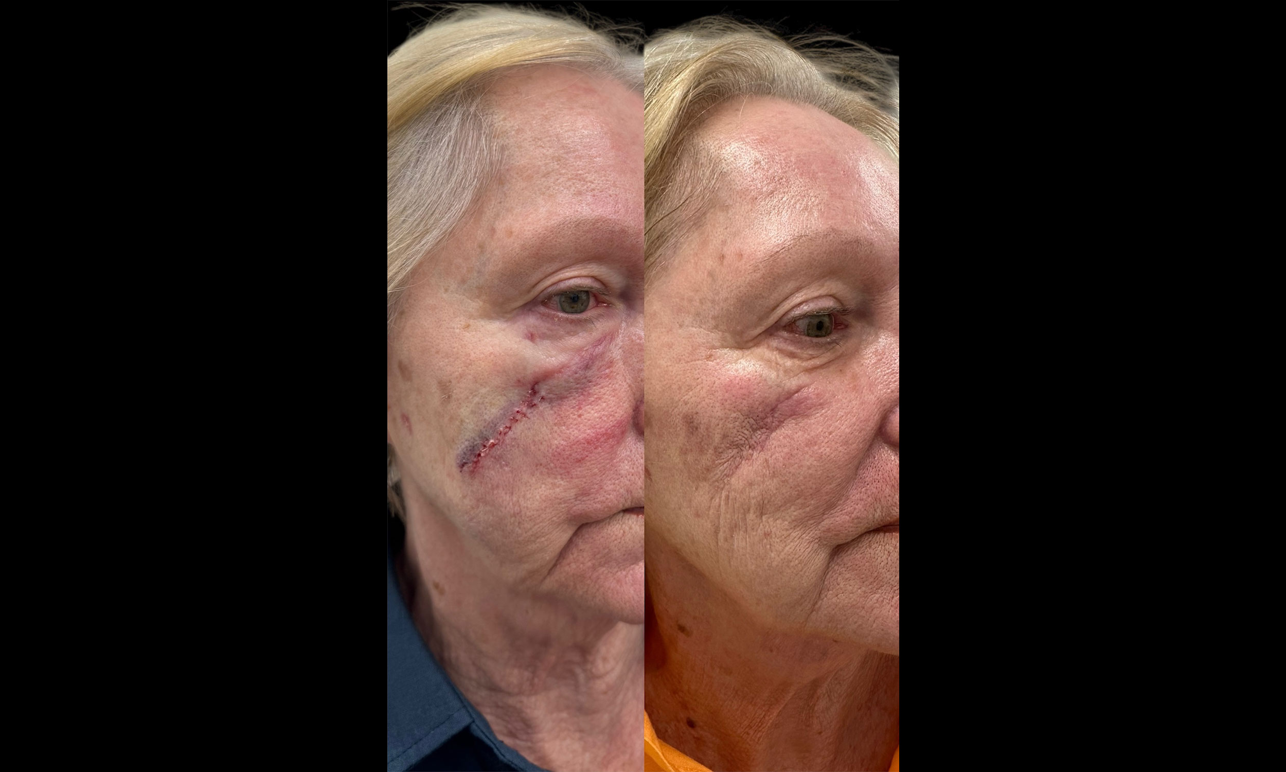 Laser Treatment – Patient 8 Before