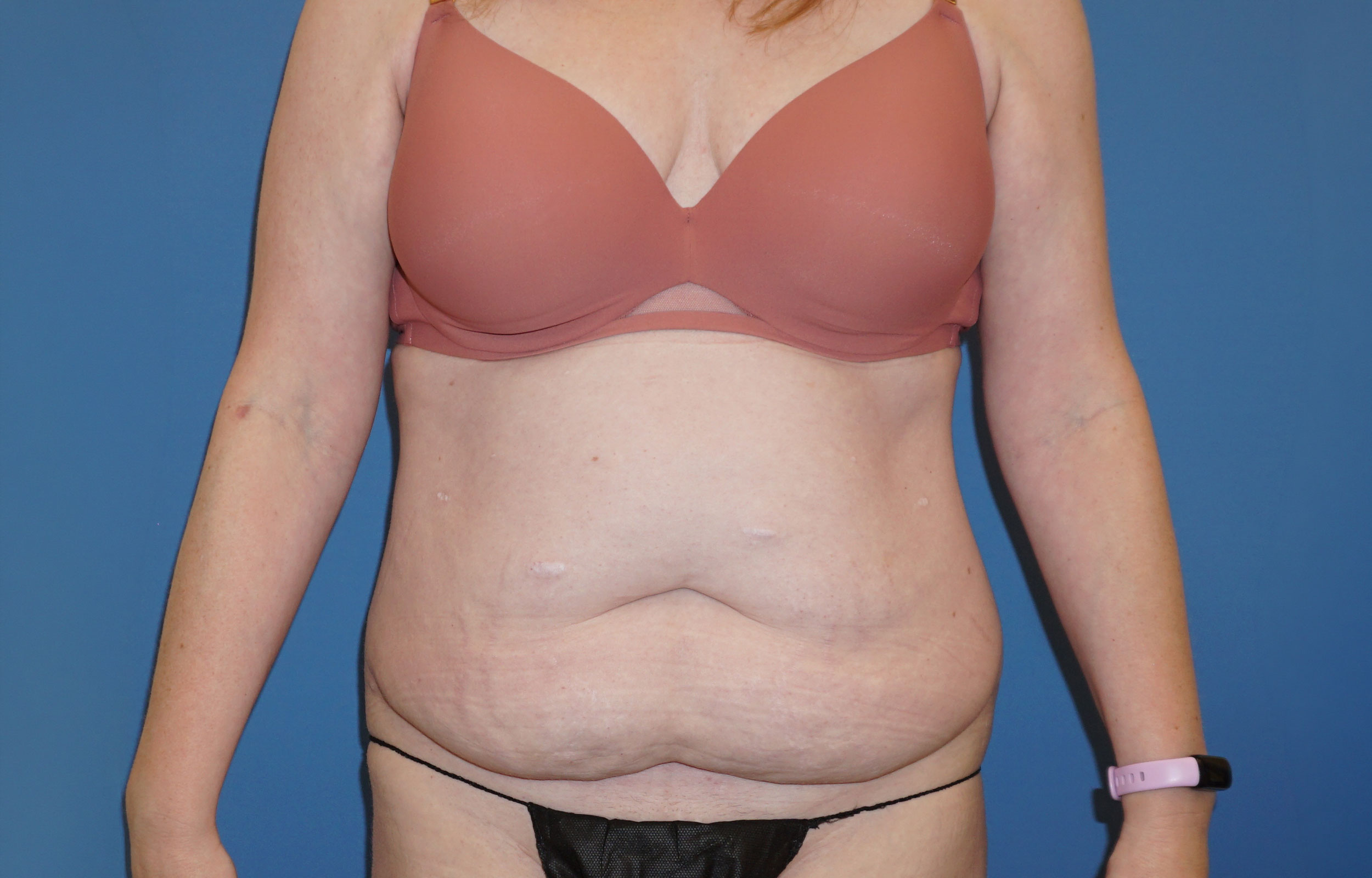 Tummy Tuck – Patient 14 Before