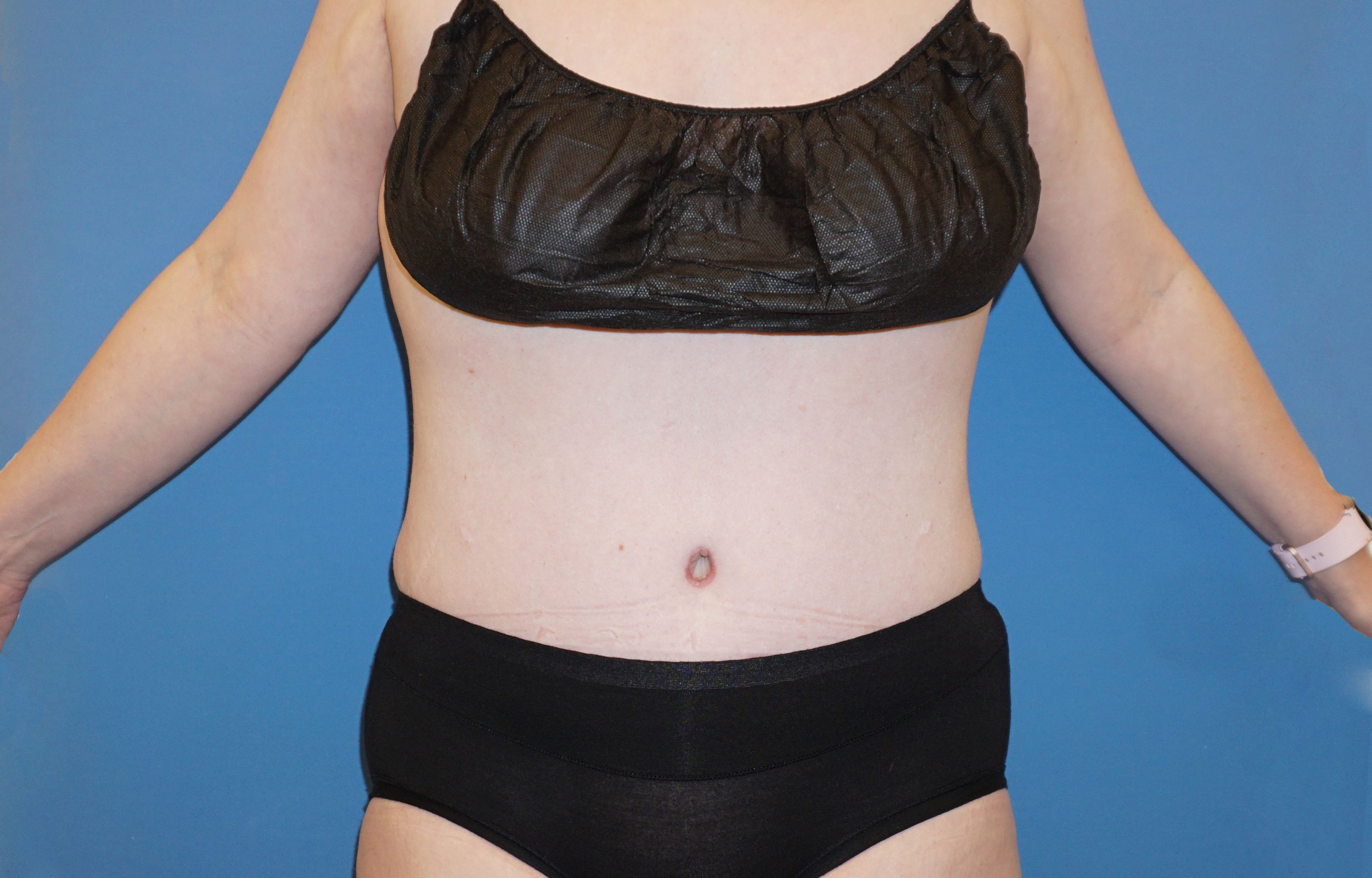 Tummy Tuck – Patient 14 After