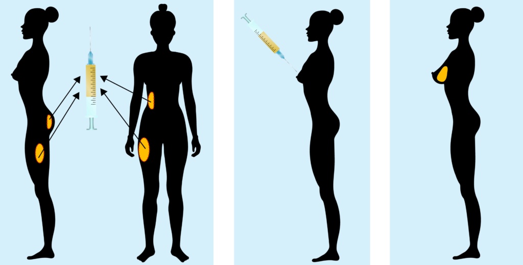AlloClae and Fat Transfer