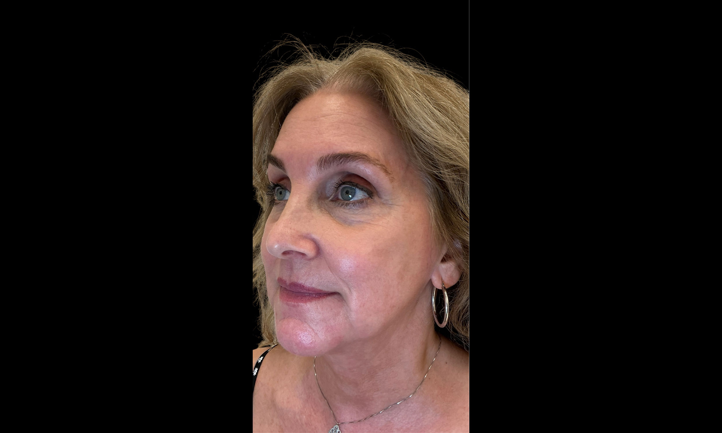 Laser Treatment Patient 12 – Side Angle After