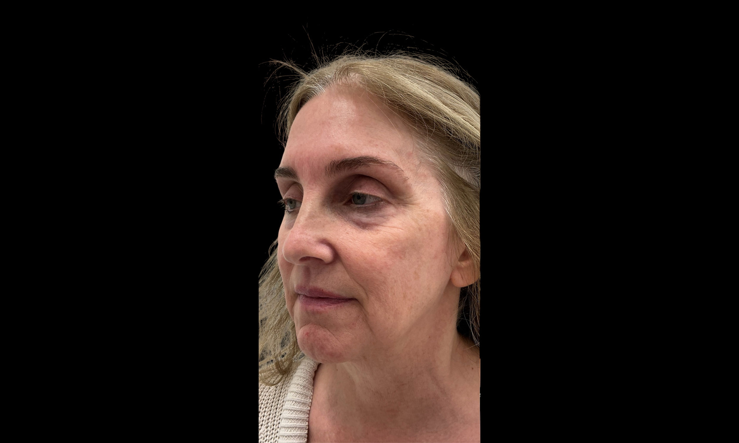 Laser Treatment Patient 12 – Side Angle Before