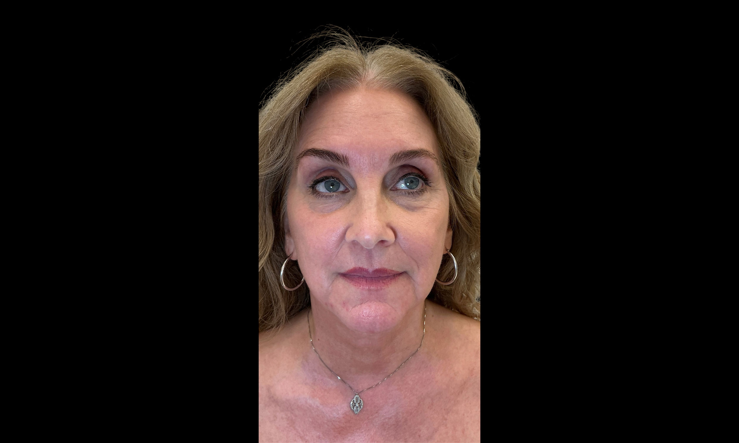 Laser Treatment Patient 12 – After