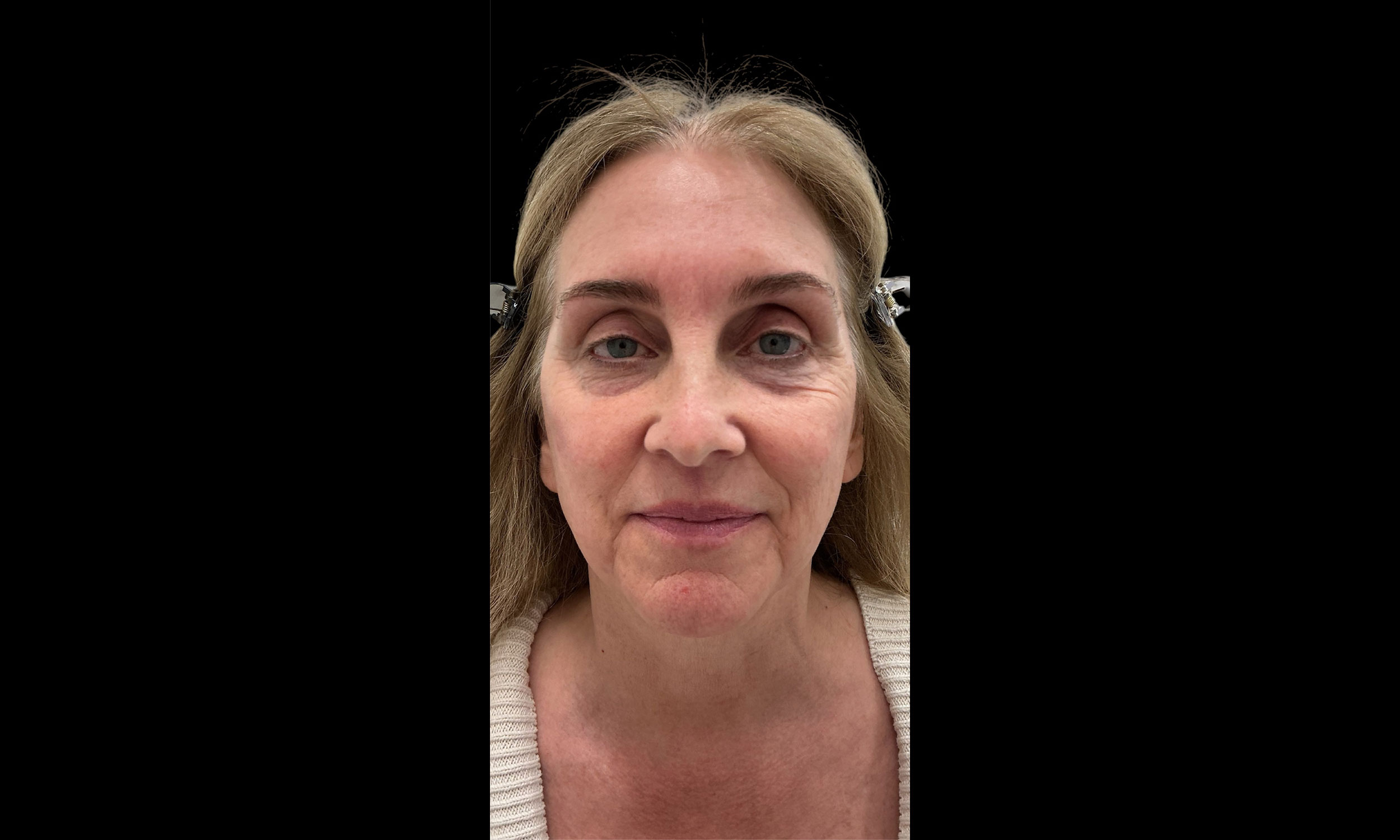 Laser Treatment Patient 12 – Before