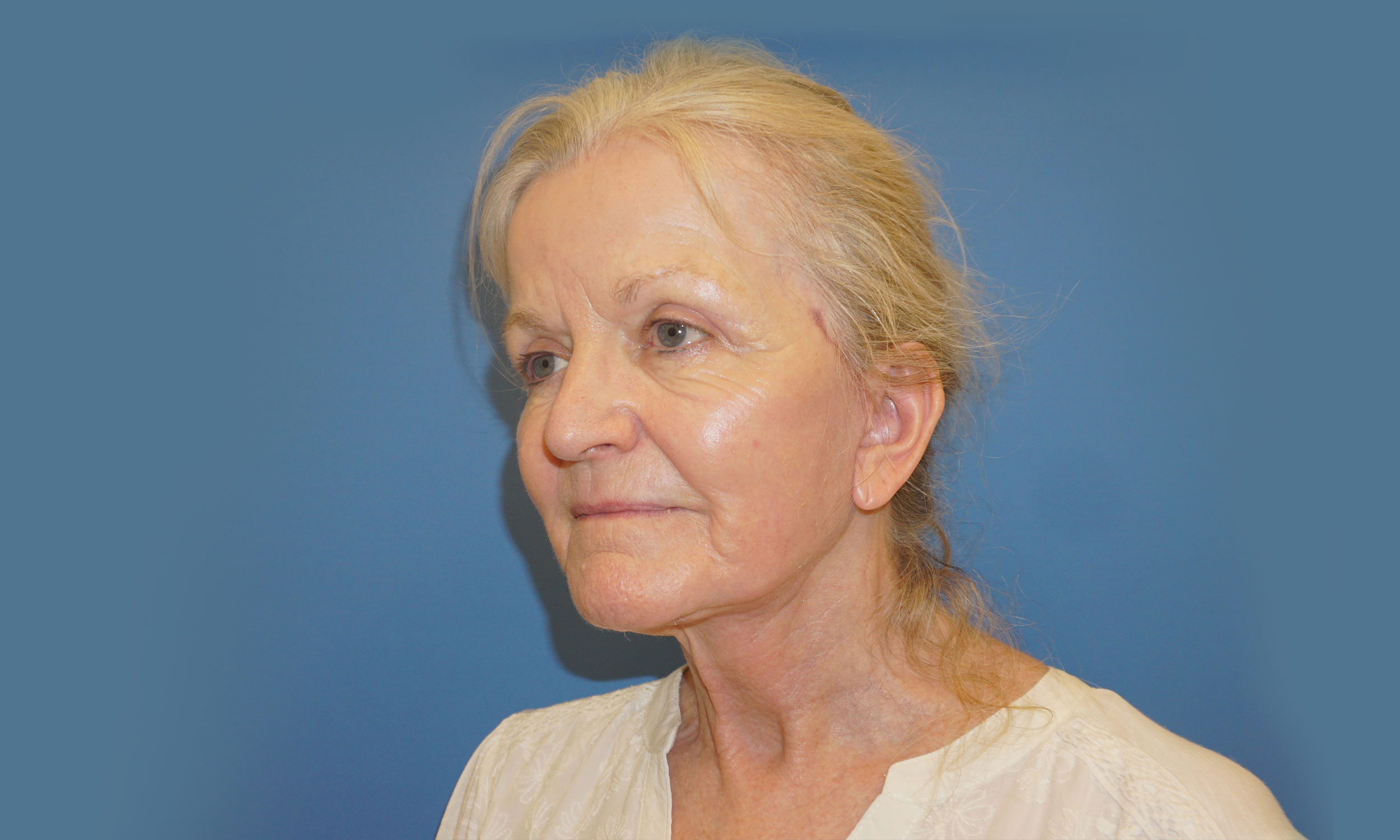 Facelift Patient 5 – After Side