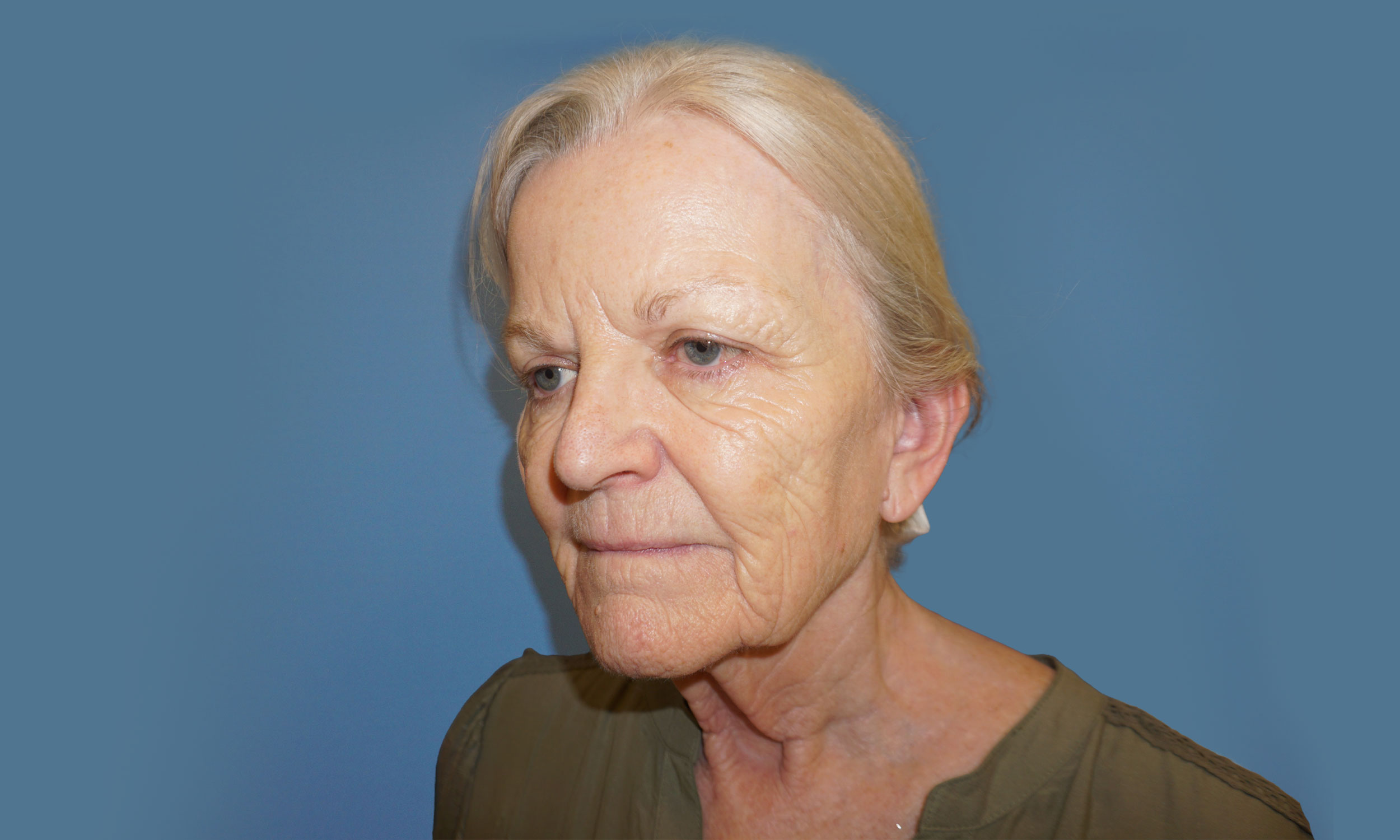 Facelift Patient 5 – Before Side
