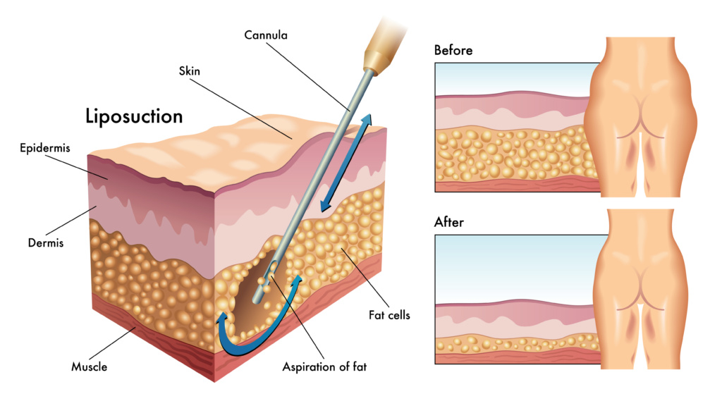 liposuction charlotte nc