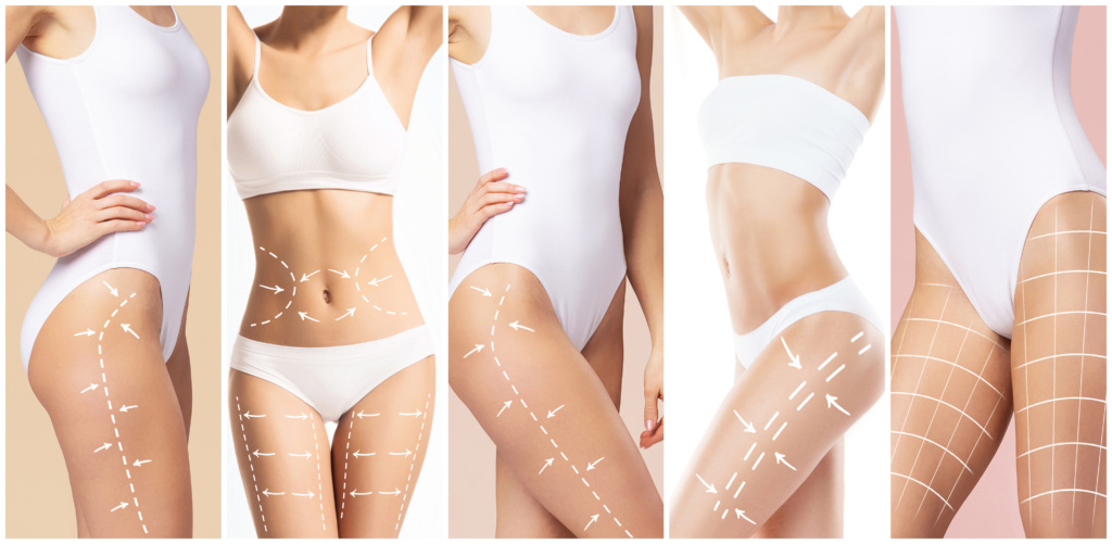 liposuction charlotte nc