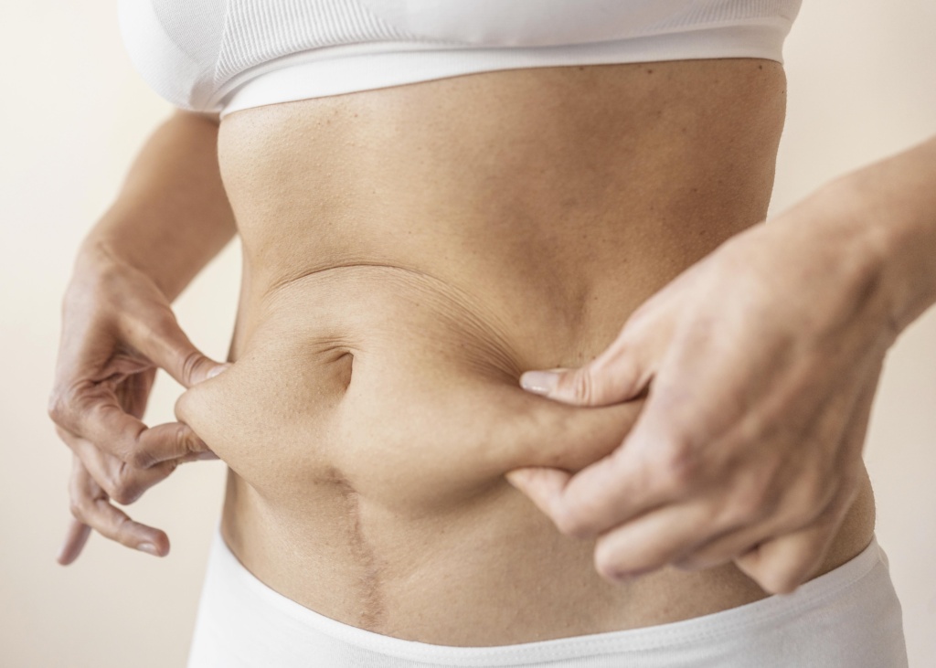 liposuction charlotte nc