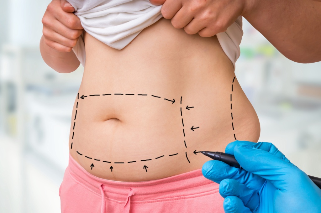 liposuction charlotte nc