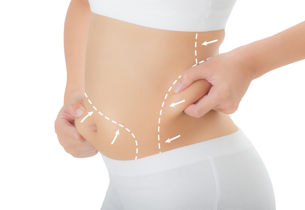 liposuction charlotte nc