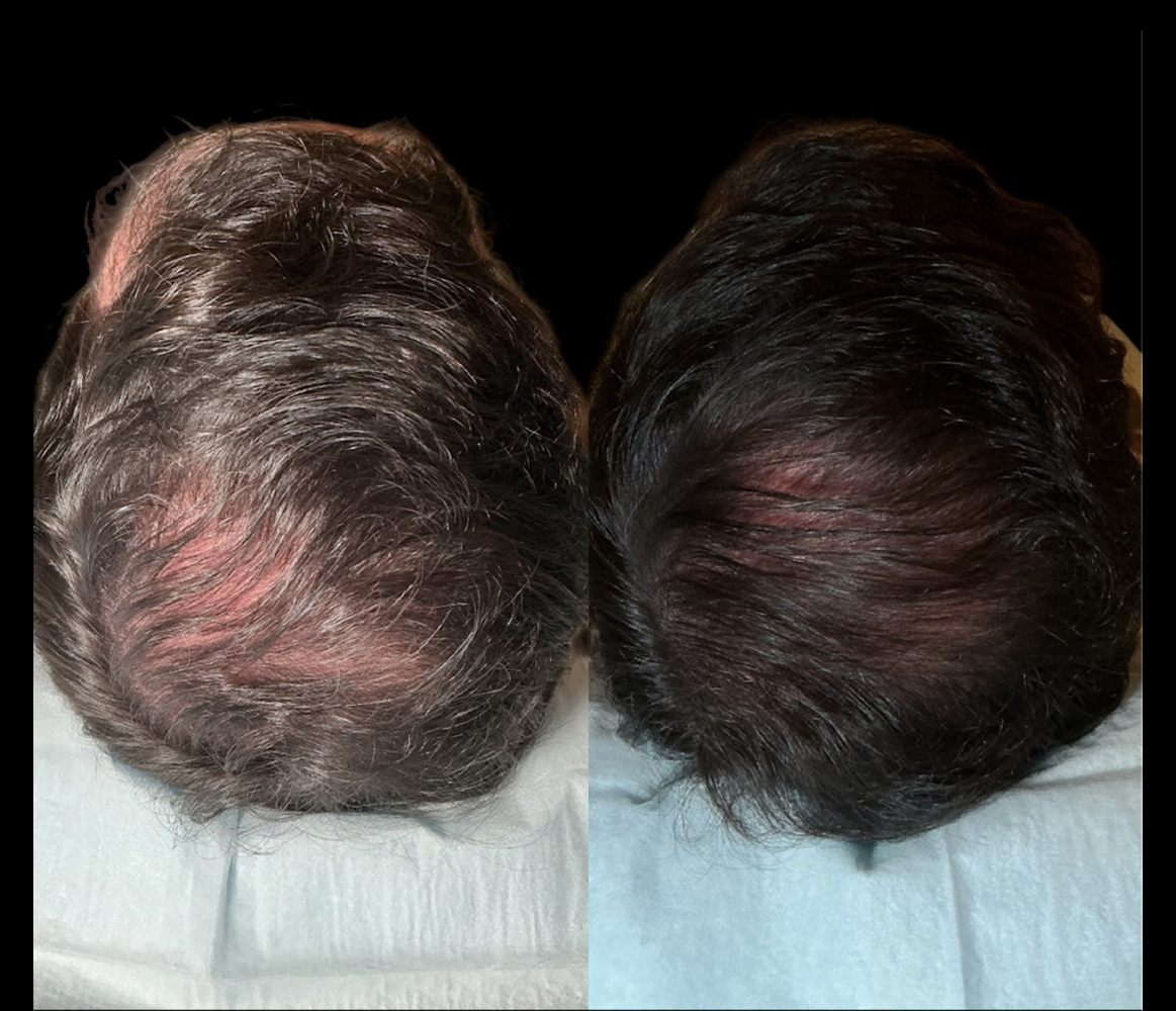 Hair Growth - Patient 3 After (2 examples of progression)