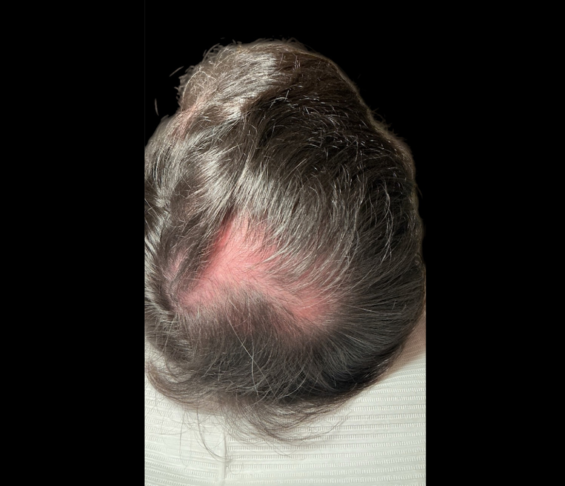Hair Growth - Patient 3 Before